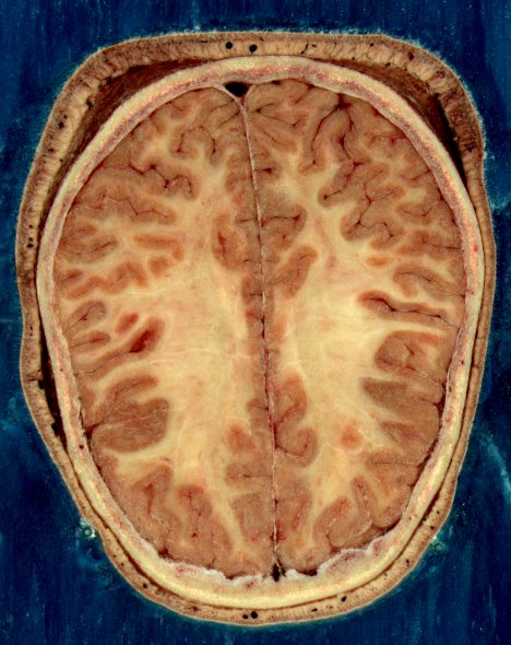 Section of the brain of an adult woman Головной мозг взрослой женщины в разрезе