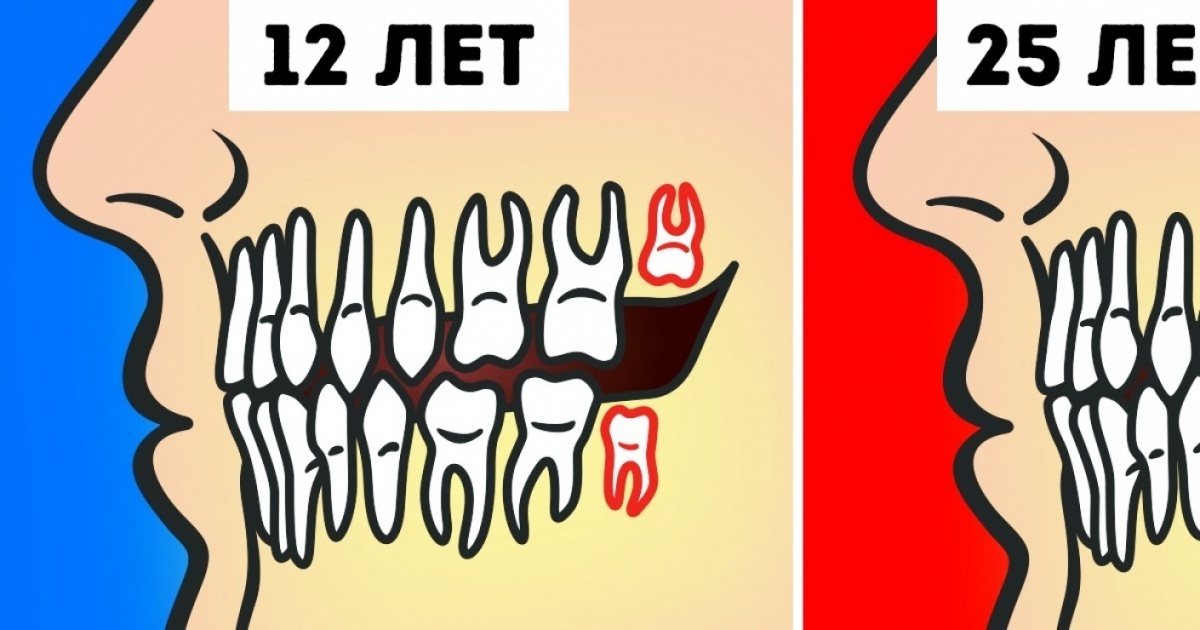 Do you really need to remove wisdom teeth? Удалять или нет зубы мудрости
