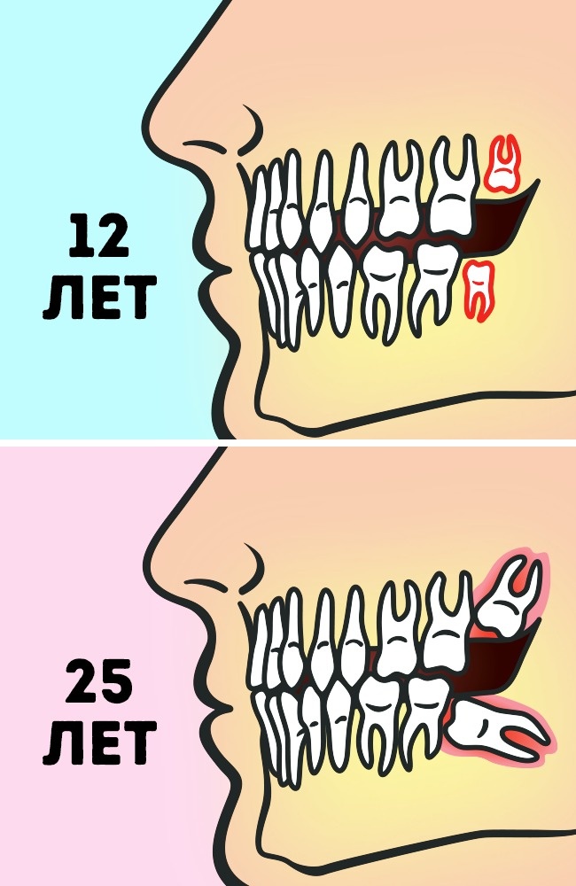 Do you really need to remove wisdom teeth? Удалять или нет зубы мудрости