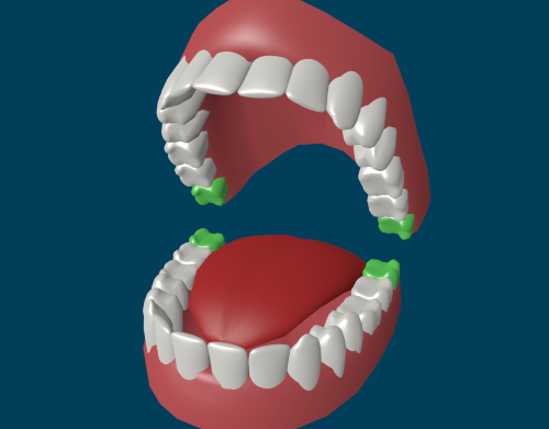Do you really need to remove wisdom teeth? Удалять или нет зубы мудрости
