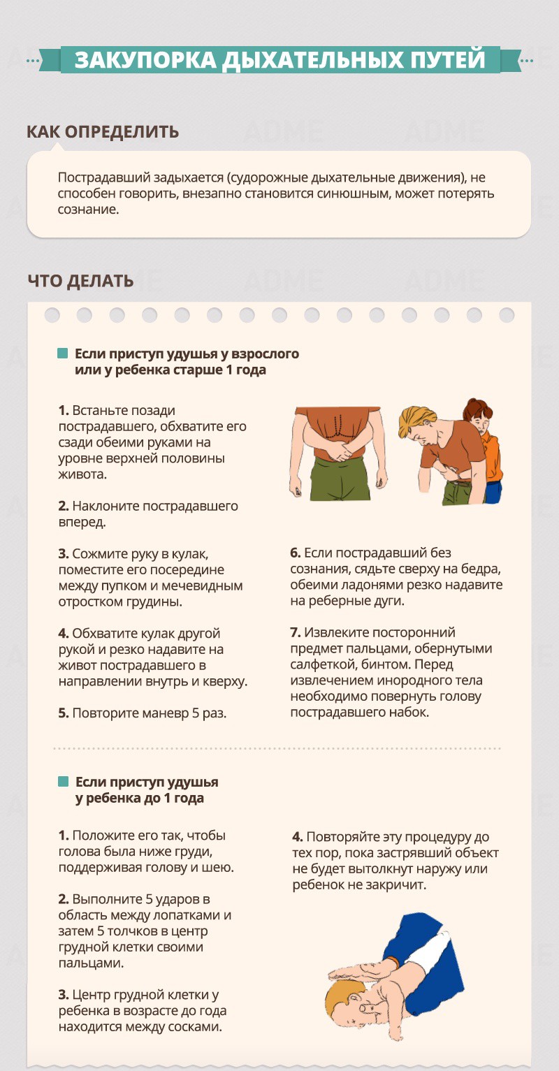 Obstruction of the respiratory tract - First Aid Guide Закупорка дыхательных путей - Гид по оказанию первой помощи