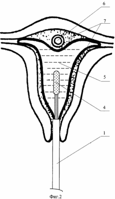 METHOD AND DEVICE FOR PREVENTING PREGNANCY