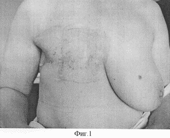METHOD OF TREATMENT OF LOCAL RECOMMENDATIONS OF BREAST CANCER. Patent of the Russian Federation RU2286818