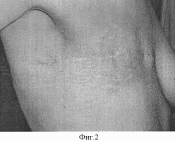 METHOD OF TREATMENT OF LOCAL RECOMMENDATIONS OF BREAST CANCER. Patent of the Russian Federation RU2286818