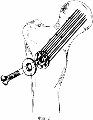 METHOD OF OPERATIONAL TREATMENT OF MEDICAL FRACTURES OF THE CORD OF THE FEMALE BONE