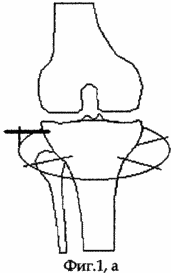 METHOD FOR TREATMENT OF DEFORMING ARTHROSIS OF THE KNIFE JOINT