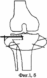 METHOD FOR TREATMENT OF DEFORMING ARTHROSIS OF THE KNIFE JOINT