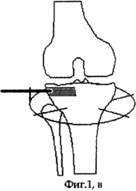 METHOD FOR TREATMENT OF DEFORMING ARTHROSIS OF THE KNIFE JOINT