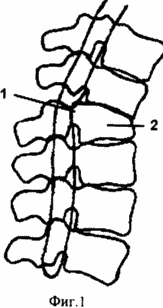 METHOD OF SURGICAL TREATMENT OF CONSEQUENCES OF FRACTURES OF SPINS