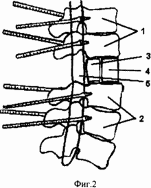 METHOD OF SURGICAL TREATMENT OF CONSEQUENCES OF FRACTURES OF SPINS