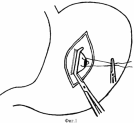 METHOD OF SURGICAL TREATMENT OF COMPLICATED ulcers of the posterior stenosis of the stomach