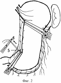 METHOD OF GASTRAP REACTION