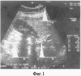 METHOD OF SELECTING OPERATIONAL ACCESS AT CHOLECYSTECTOMY IN PATIENTS WITH ACUTE DESTRUCTIVE CHOLECYSTITIS