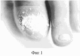 METHOD OF TREATMENT OF ONYCHOMICOSIS BY COMBINED PREPARATION